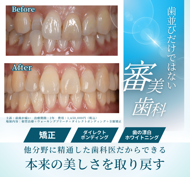 他分野に精通した歯科医だからできる歯並びを整えるだけではない審美歯科 【主訴】前歯が痛い【治療期間】2年・26回【治療内容】マイクロスコープによる根管治療+ウォーキングブリーチ+ダイレクトボンディング+全顎矯正【治療費用】165万円(税込)