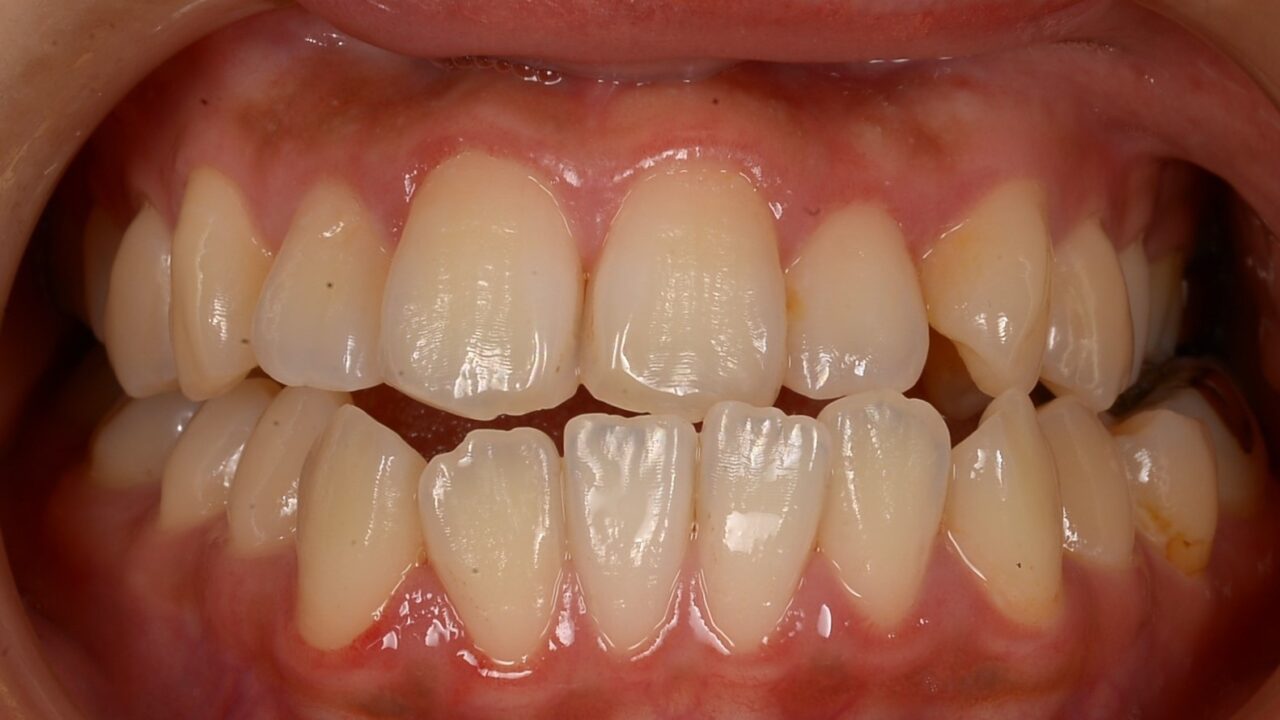 Before