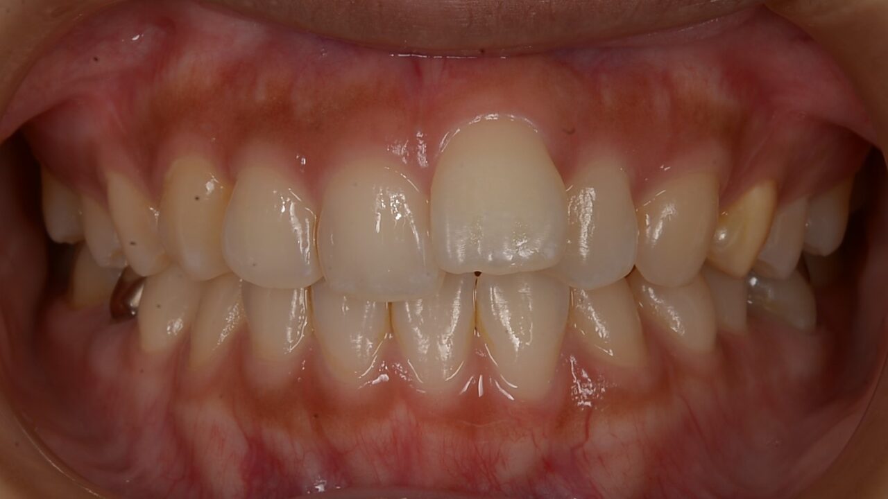 Before