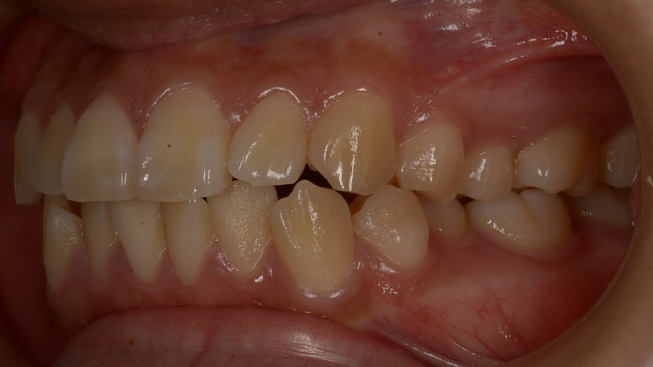 Before