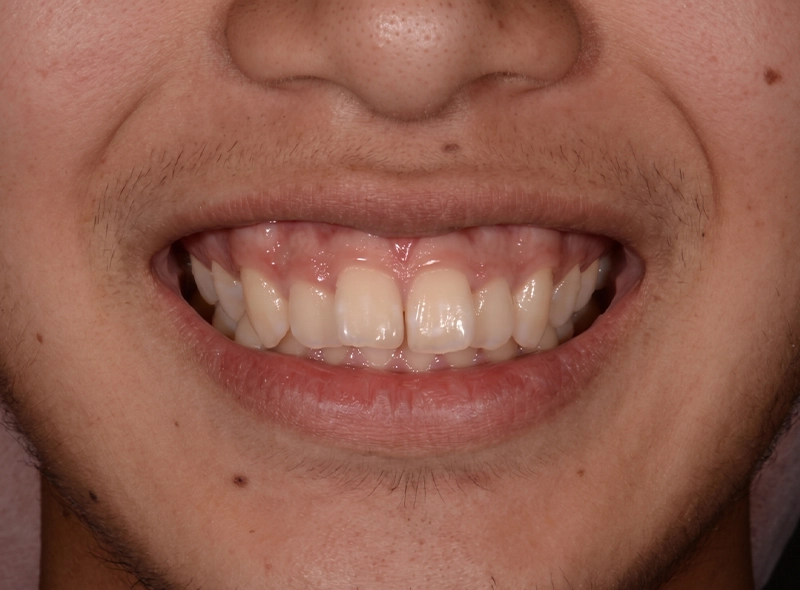 Before